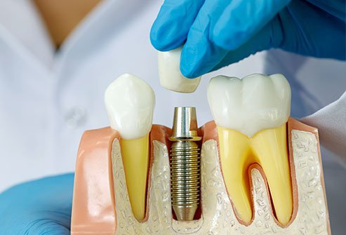 Dental Implants Procedure, Cost, Types, Problems & Safe